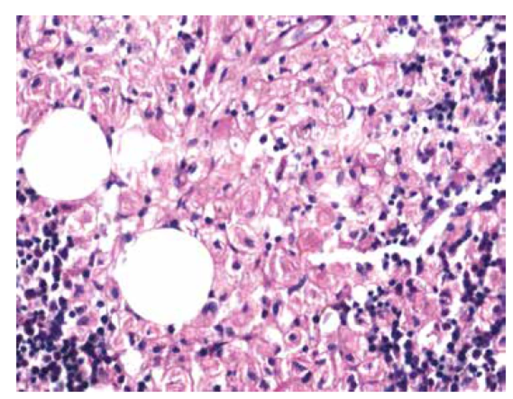 Histochemické barvení PAS s pozitivitou gaucherových buněk (zvětšení
200x).