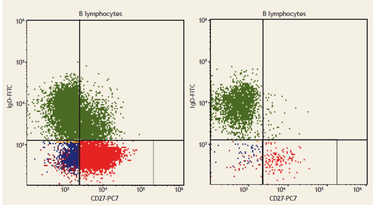 Flow cytometry. Switched memory B lymphocytes (CD19+CD27+IgD-), displayed as red dots. On the left:
a healthy blood donor; Switched memory B lymphocytes (CD19+CD27+IgD-) comprise 3% of all B lymphocytes.
On the right: a patient with coeliac disease; Switched memory B lymphocytes (CD19+CD27+IgD-) comprise 1.5%
of all B lymphocytes.<br>
Obr. 2. Průtoková cytometrie. Paměťové B lymfocyty (CD19+CD27+IgD-), zobrazeny jako červené tečky. Vlevo: zdravý dárce
krve; paměťové B lymfocyty (CD19+CD27+IgD-) tvoří 3 % všech B lymfocytů. Vpravo: pacient s celiakií;paměťové B lymfocyty
(CD19+CD27+IgD-) tvoří 1,5 % všech B lymfocytů.
