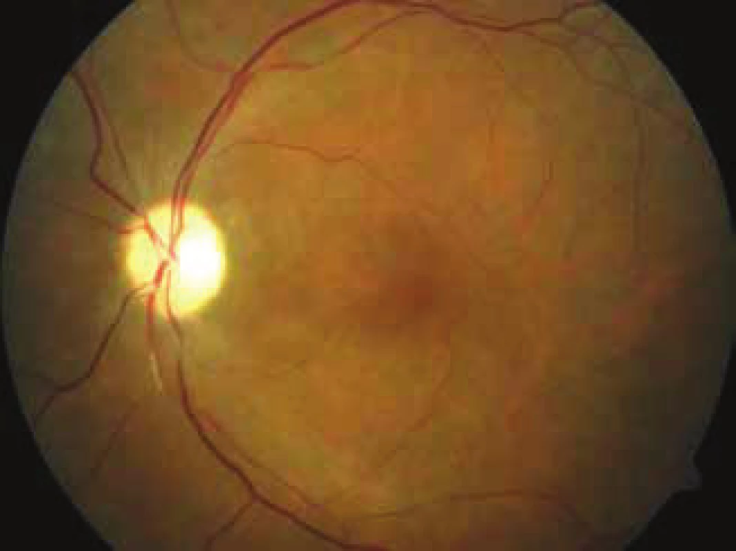 Photograph of ocular fundus of left eye 4 weeks after
procedure