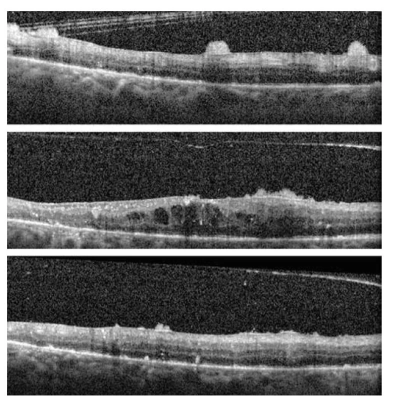 Horizontálne OCT scany makuly pravého oka s diskrétnym edémom makuly a na povrchu
sietnice sa nachádzajú hrudky hyperdenzného materiálu