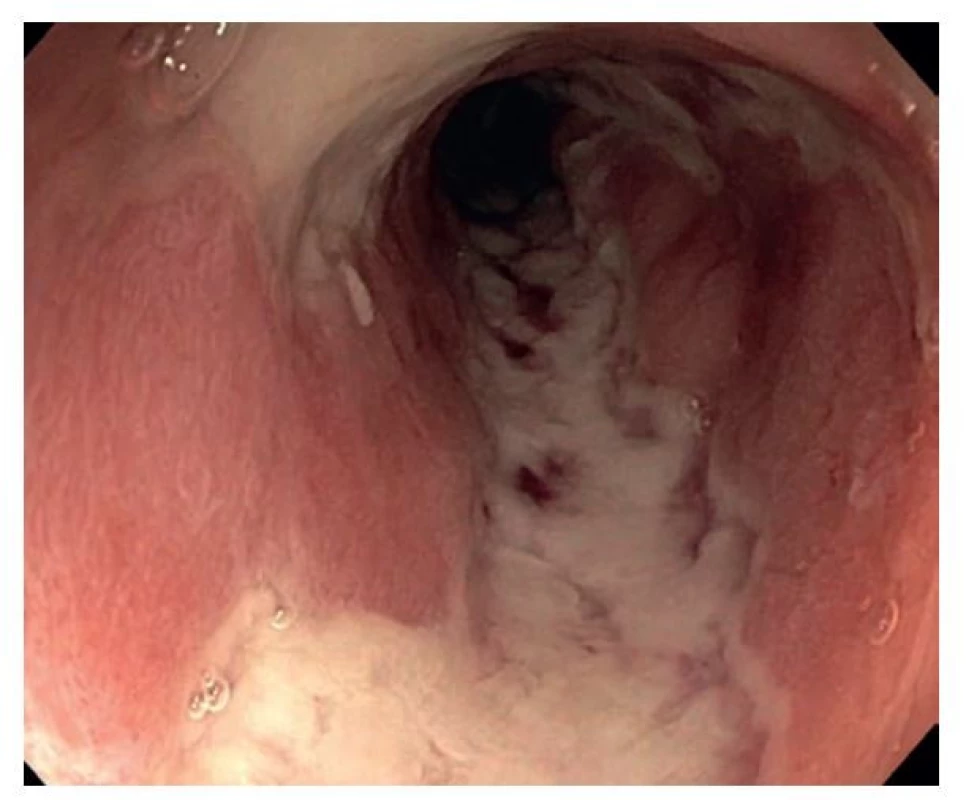 Endoskopický snímek terminálního ilea s plazivými ulceracemi
u pacienta s aktivní Crohnovou chorobou (publikováno se souhlasem Kliniky
hepatogastroenterologie, Institut Klinické a Experimentální Medicíny,
Praha).