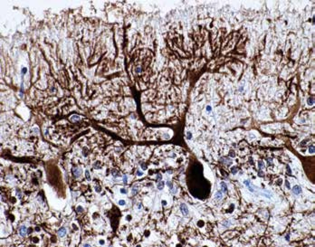 Abnormálne vetvenie dendritov Purkyňových buniek (farbenie NF,
zväčšenie 400x)