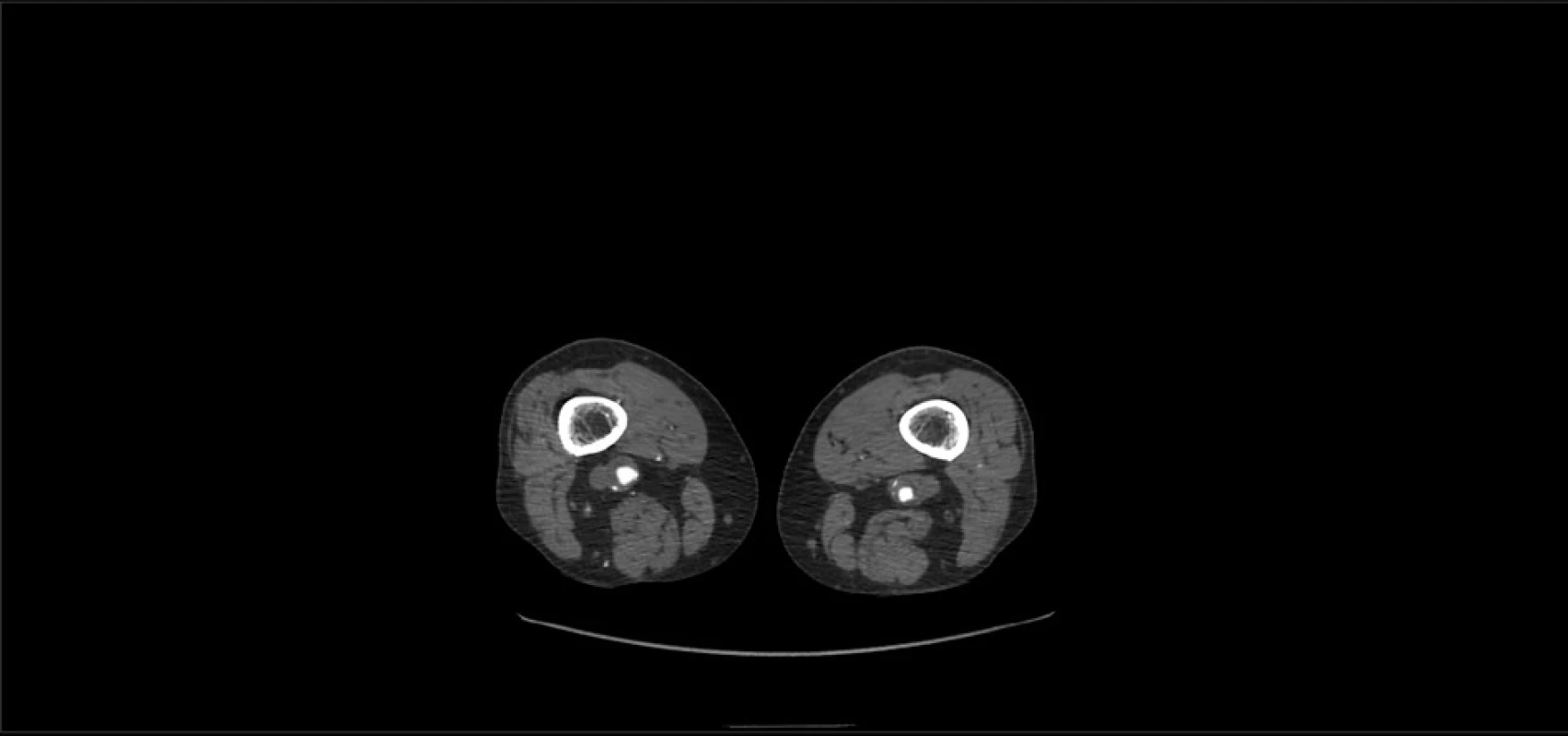 CT angiografie – výdutě podkolenních tepen –
příčný řez<br>
Fig. 2: CT angiography – popliteal artery aneurysms –
cross-section