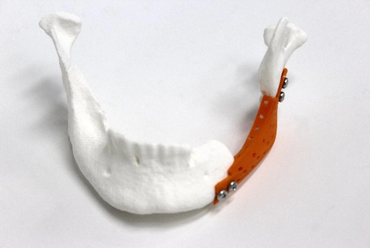 3D Printed models of a) mandibular implant and b) mandibular implant positioned and fixed on the mandible and TMJ.