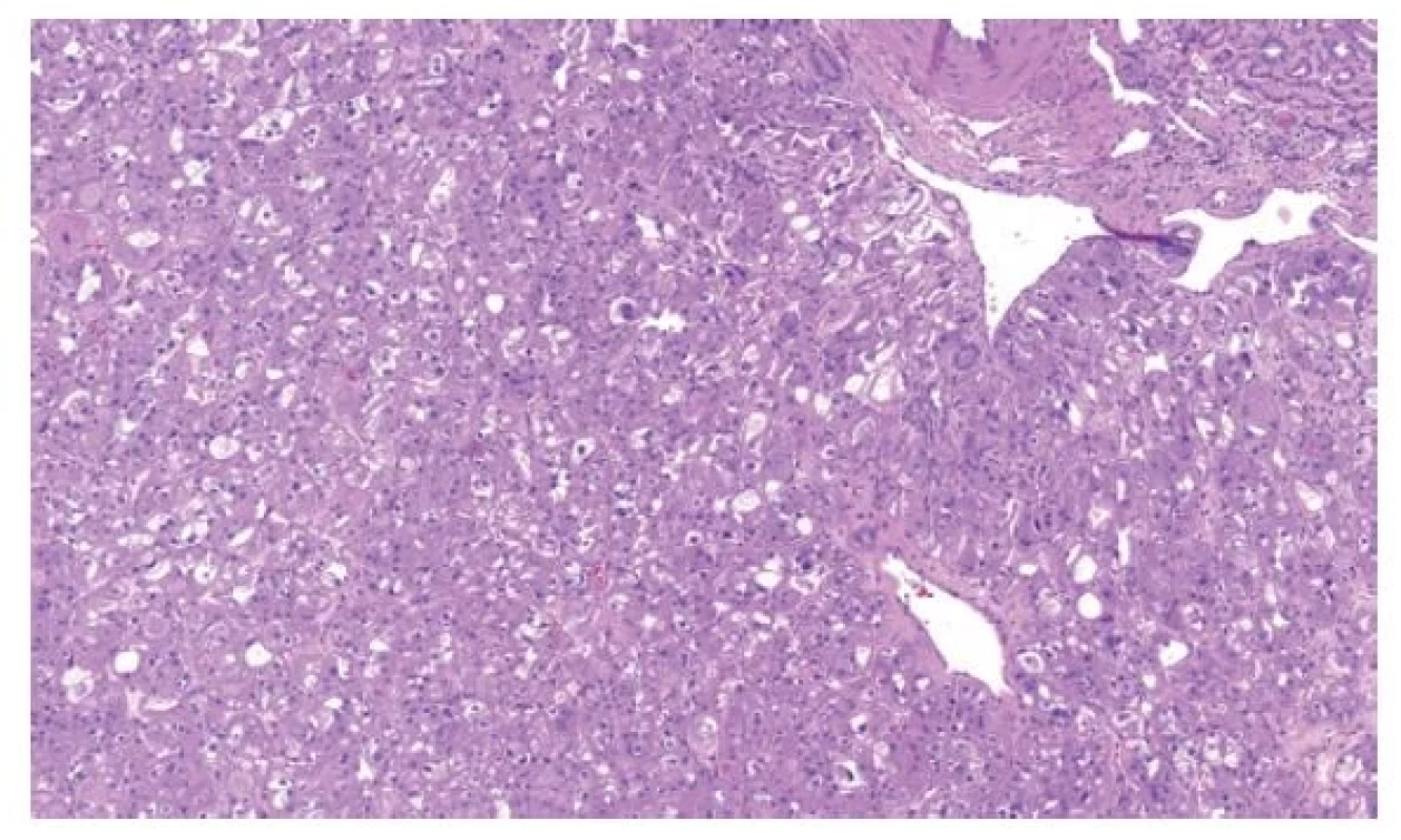 EVT je solidní tumor tvořený objemnými onkocytickými buňkami
s velkými vakuolami a „high-grade“ jádry.