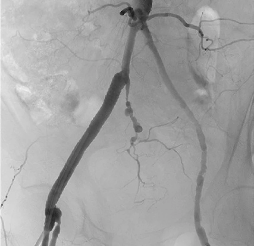 Stentgraft a. iliaca interna dextra<br>
Fig. 5. Right internal iliac artery stent graft