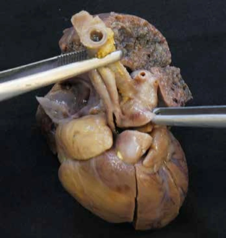 Interrupce aortálního oblouku. U levé pinzety patrná ascendentní
aorta s odstupem pravostranné a. subclavia a a. carotis communis, u pravé
pinzety pak truncus pulmonalis, pokračující přes ductus arteriosus v descendentní
aortu.
