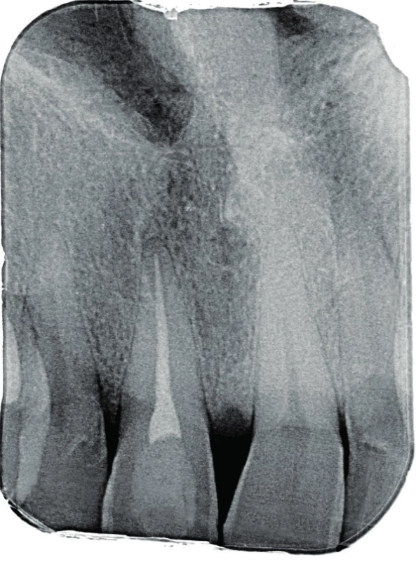 Diagnostický
intraorální rentgenový
snímek zubu 11
v apikálním zastavení
při konziliárním
vyšetření