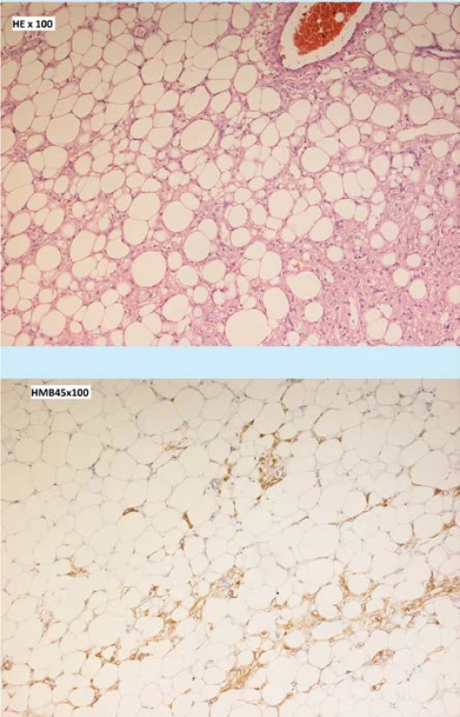 Histologický nález angiomyolipom v barvení
hematoxylin-eosin (a) a pozitivita HMB45 v perivaskulárních epiteloidních buňkách (b).<br>
Fig. 3. Histological finding of angiomyolipoma in
hematoxylin-eosin staining (a) and HMB45 positivity
in perivascular epithelioid cells (b).