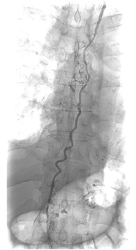 Skiaskopické zobrazení ductus thoracicus podáním
jodové kontrastní látky do mikrokatétru <br> 
Fig. 5. Fluoroscopy of thoracic duct during administration
of iodine contrast medium into microcatheter
