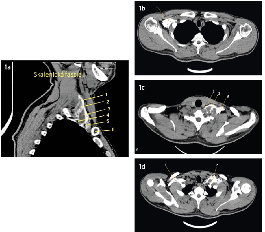Série CT obrazů po podání 30 ml fyziologického
roztoku do interskalenického prostoru na pravé straně a 30 ml
fyziologického roztoku infraklavikulárně na straně levé (sec.
Nalos) a CT šikmý řez krční oblastí s náplní skalenické fascie
1a Střední skalenický sval
1 – náplň interfasciálního prostoru, 2 – brachiální plexus, 3 –
přední skalenický sval, 4 – arteria subclavia, 5 – v. subclavia,
6 – klíční kost
Na snímku je patrné, že v tomto objemu tekutiny je obalena
jugulární žíla, n. phrenicus a tekutina vzlíná i do hrudníku.
1b Příčný řez krční oblastí (Th1). Náplň skalenického prostoru.
1 – nervus phrenicus, 2 – brachiální plexus, 3 – n. suprascapularis
1c Příčný řez krční oblastí (Th3). CT obraz oboustranné náplně
pochvy brachiálního plexu. Pravá část: náplň po aplikaci do
infraklavikulárního prostoru je patrné ztenčení náplně podaného
roztoku; levá část: náplň po aplikaci do interskalenického
prostoru.
1d Řez ve výši Th 4. Pravá část: náplň pochvy brachiálního plexu
po aplikaci do infraklaviklárního prostoru; vlevo již kontrastní
látka není vidět.