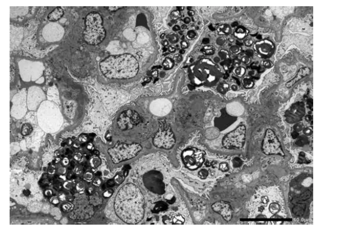 ELMI. Ultrastruktura úseku glomerulu s koncentrickými lamelárními inkluzemi,
které jsou převážně akumulované v podocytech. V některých řezech
jsou inkluze zastiženy podélně s pruhovitým vzorem, pro které se užívá termín
„zebra bodies“. Podocyty představují nejvíce postižené buňky v ledvinách.