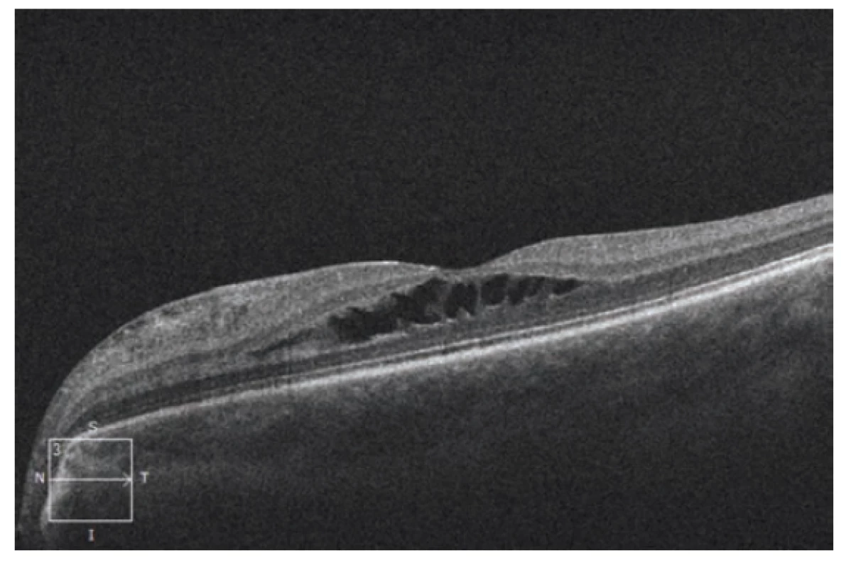 HD-OCT: Lineární horizontální transfoveolární
sken levého oka s obrazem schisis-like makulopatie se
separací v oblasti středních retinálních vrstev
