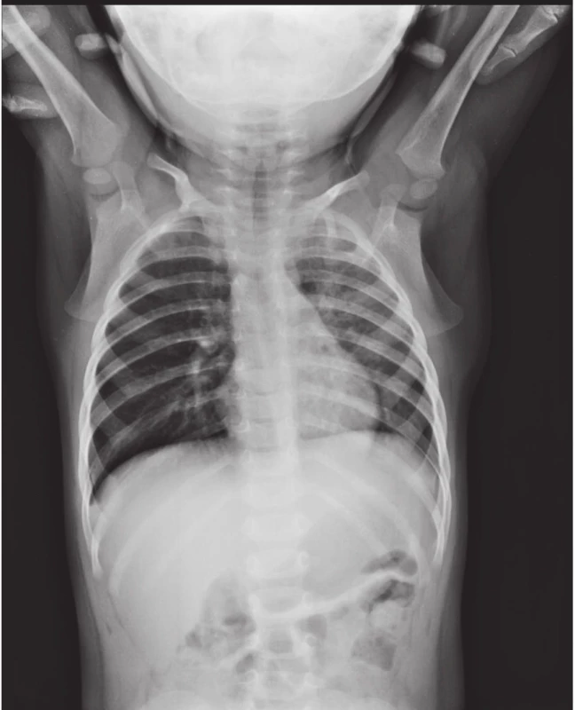 Rentgenový snímek hrudníku s obrazem zánětlivé infiltrace vlevo, více v horním a středním plicním poli.<br>Fig. 1. Chest X-ray documenting lung inflammation on the left side, predominant in the upper and middle lobe.