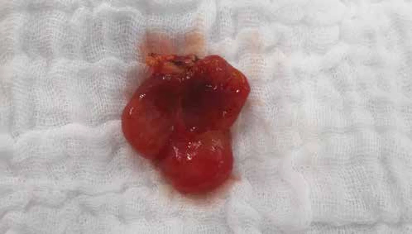Stopkatý útvar vyrůstající z gingivy horní čelisti.<br>
Fig. 3. A formation growing out of the gingiva of the upper jaw.
