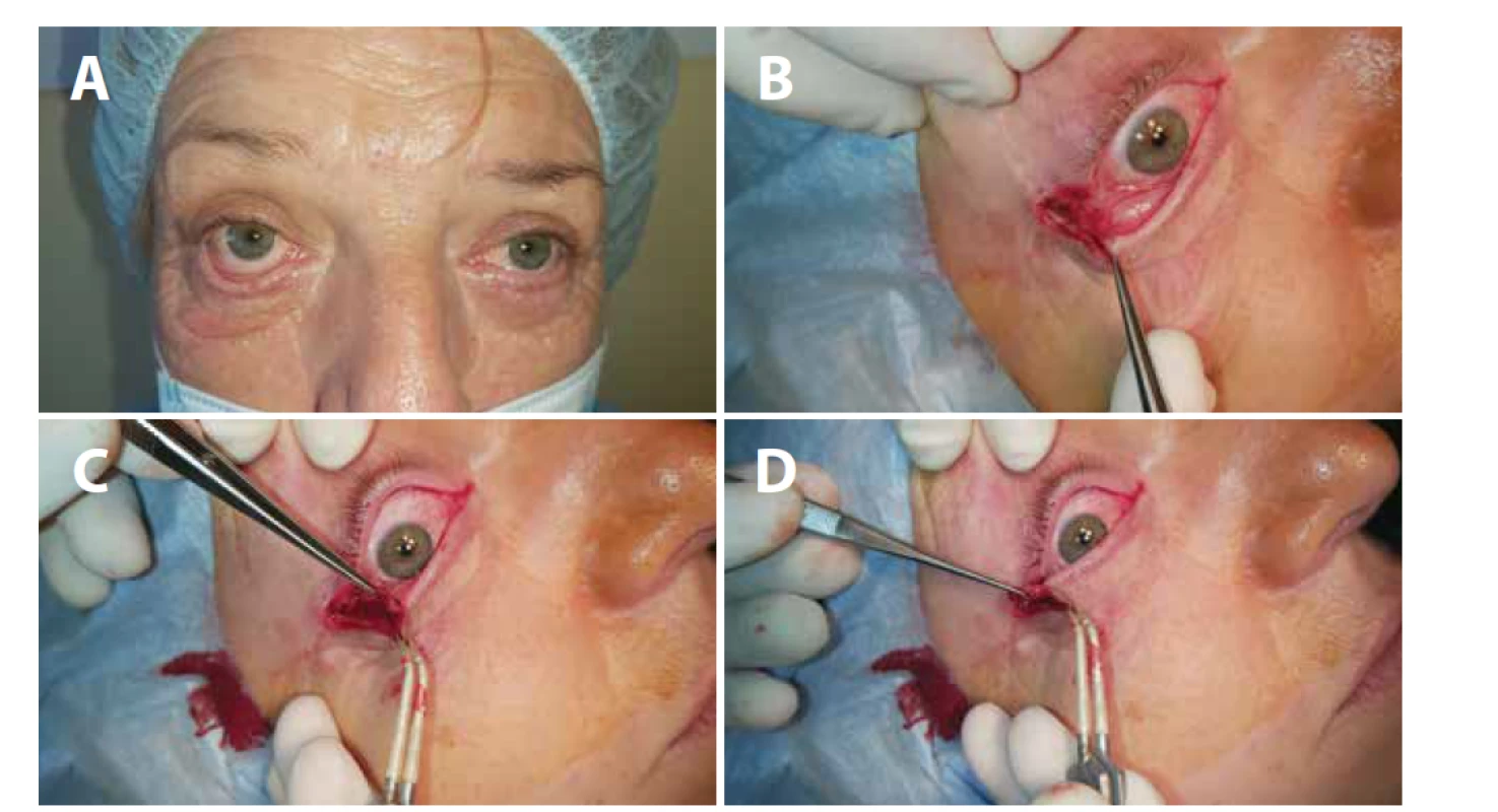 (A) Ektropium pravého oka - stav před operací, (B) kantotomie, kantolýza, (C) rozdělení zevní části víčka na přední a zadní
lamelu, (D) obnažený proužek tarzu