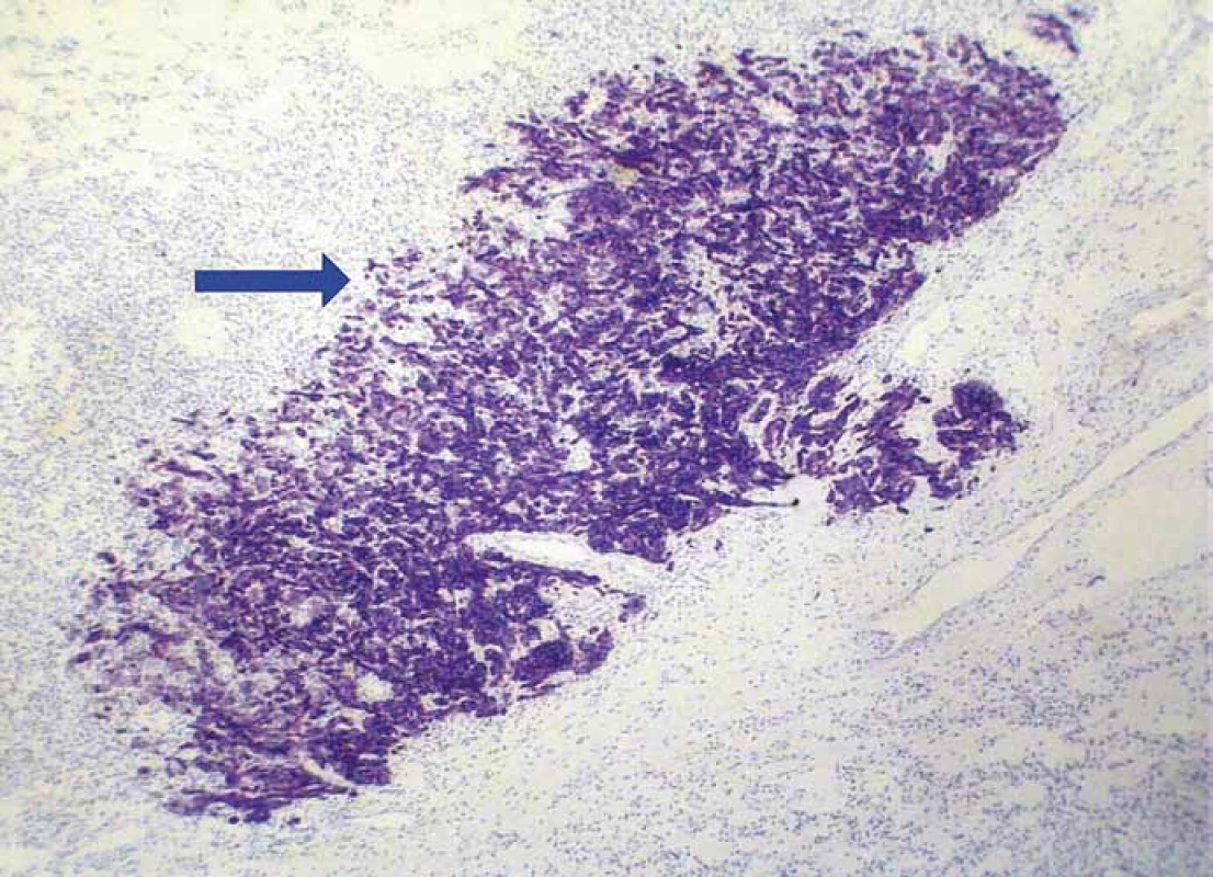 Strong immunoreactivity of metastatic adenocarcinoma for cytokeratin 7
(blue arrow), while surrounding RCC tissue is negative (clone OV-TL 12/30, magnification 100×).
