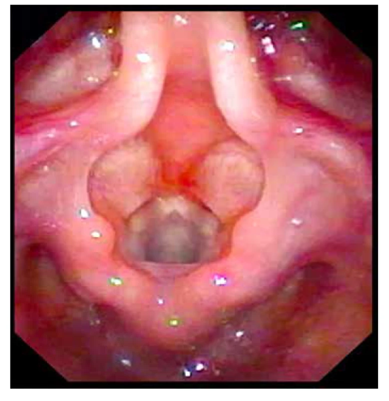 Epiglotis u 3letého dítěte