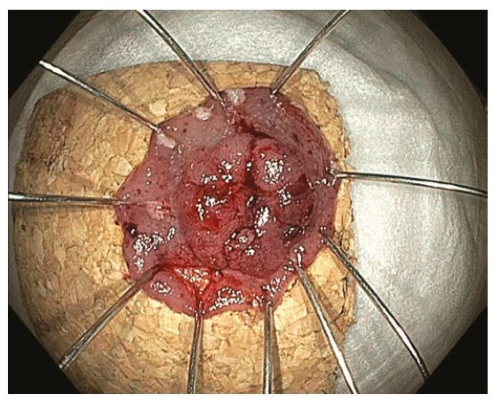 Endoskopická transmurální resekce – vybavený resekát našpendlený
na korkovou podložku, histologicky R0 resekce adenokarcinomu
s povrchovou submukózní invazí