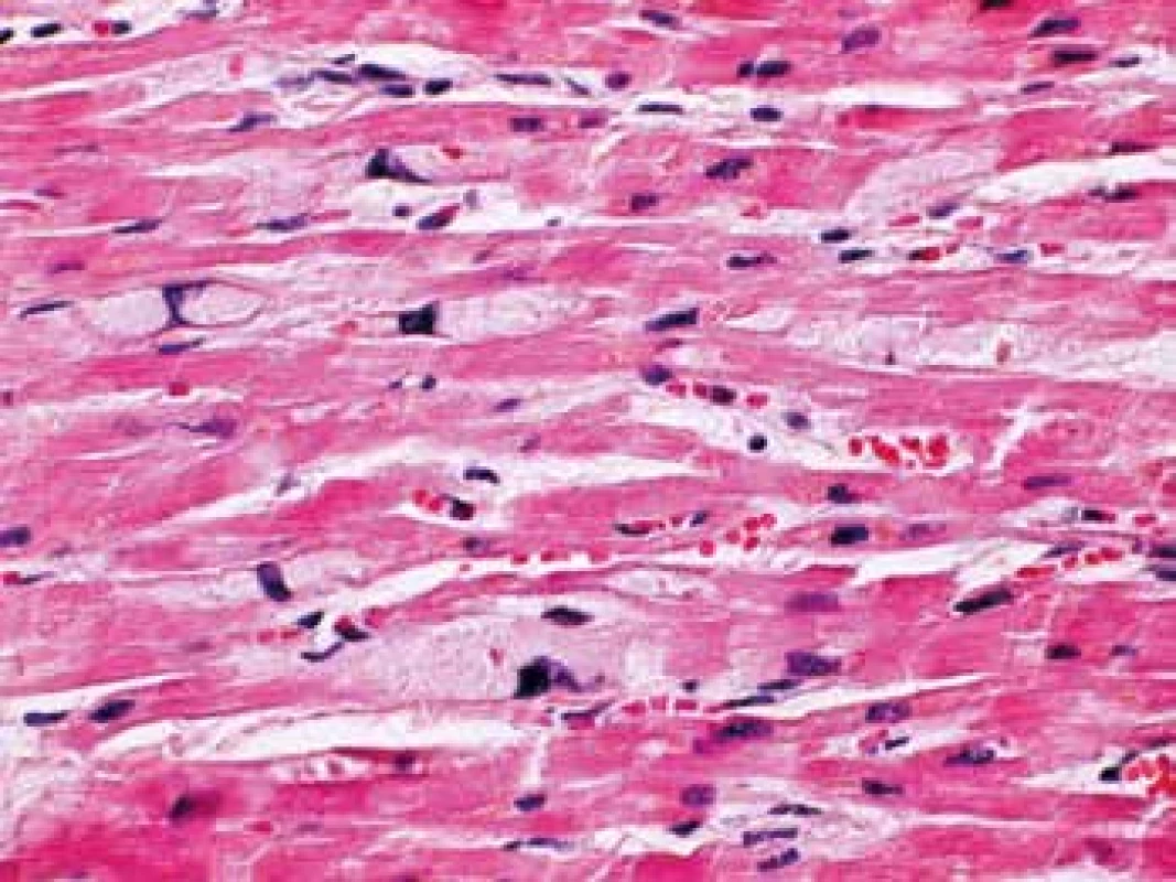Bazofilná degenerácia kardiomyocytrov (farbenie HE, zväčšenie
600x)