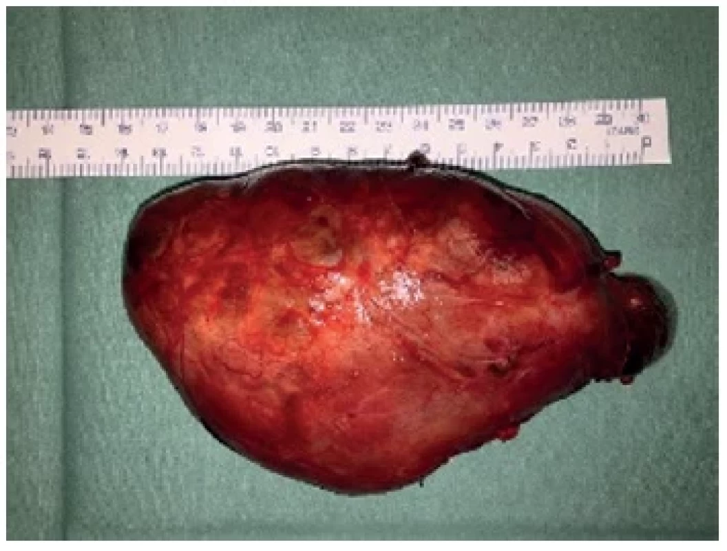 Pravostranná hemityreoidektomie – preparát <br> 
Fig. 3. Right hemithyroidectomy – specimen
