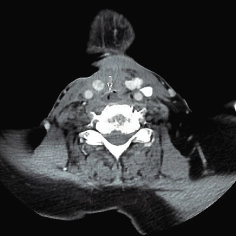 CT vyšetření, abscesové ložiska kraniálně od hlasové protézky (označeno šipkou)