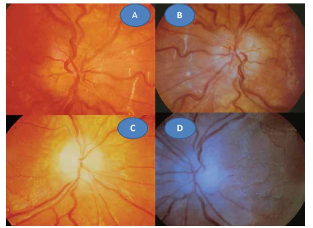 Toxoplazmová neuritida vpravo (A) a vlevo (B). Pozánětlivá atrofizace papily zrakového nervu vpravo (C) a vlevo (D)