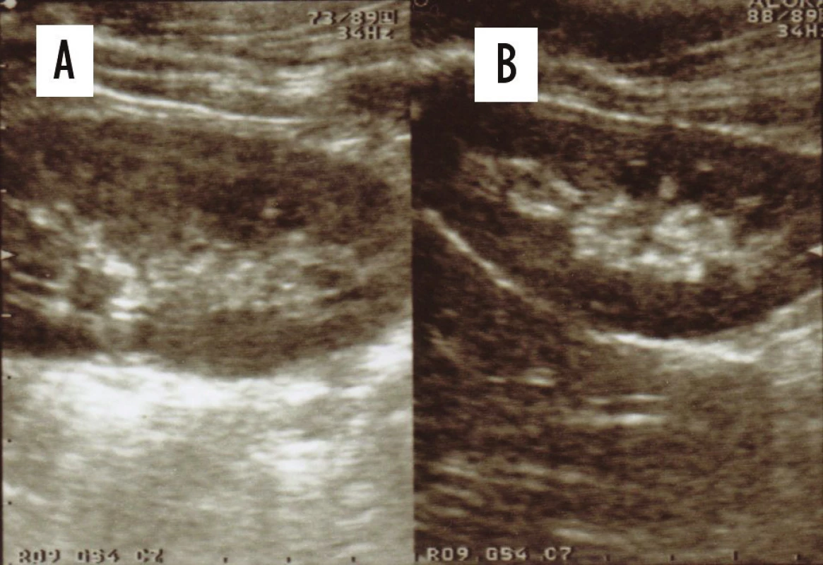USG ledvin: zvětšení levé ledviny se setřením diferenciace
centrálního echokomplexu korespondující se zánětlivými změnami
v parenchymu ledviny během akutní fáze pyelonefritidy (A) ve srovnání
se zdravou pravou ledvinou (B).