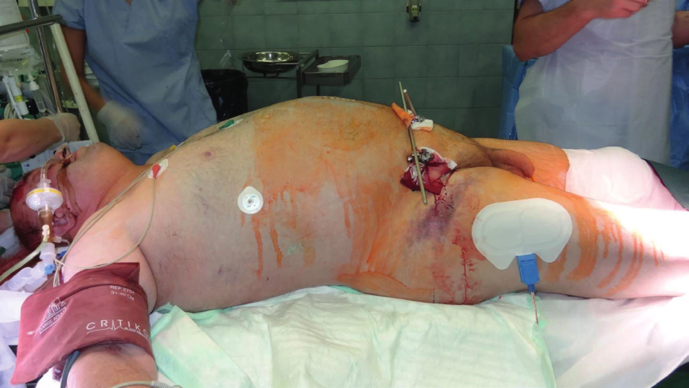 Clinical picture of ACS – abdominal wall distension