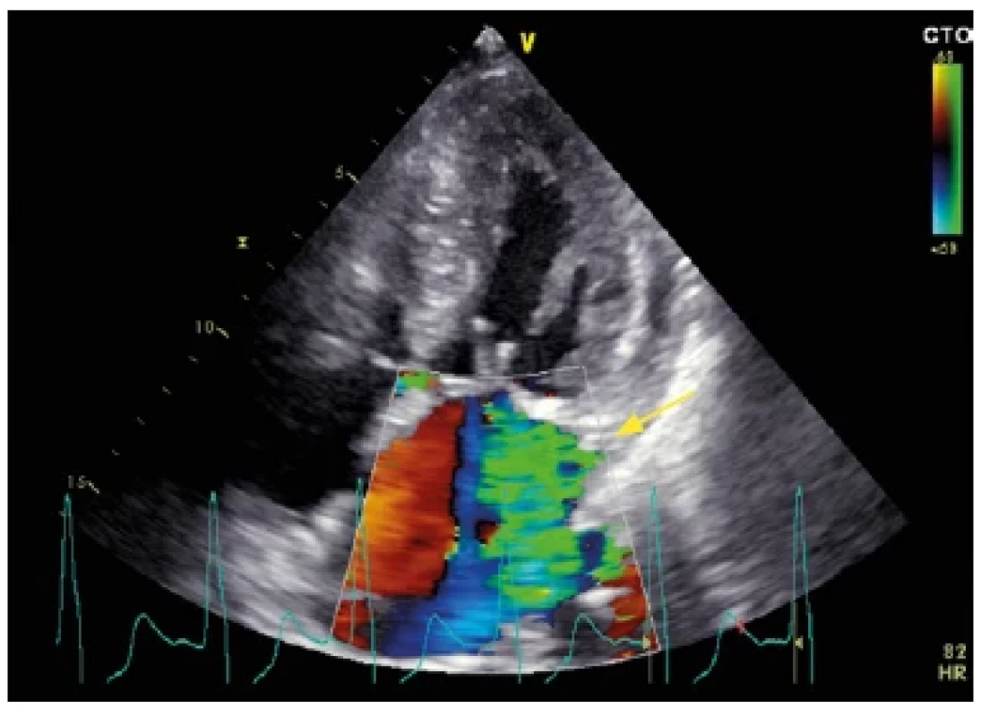 Echokardiografický nález u nemocného s hypertrofickou obstrukční
kardiomyopatií. Barevné dopplerovské mapování zobrazující mitrální
regurgitaci vznikající v důsledku dopředného pohybu předního cípu mitrální
chlopně (SAM – systolic anterior motion). Regurgitační jet je typicky
orientován posterolaterálně