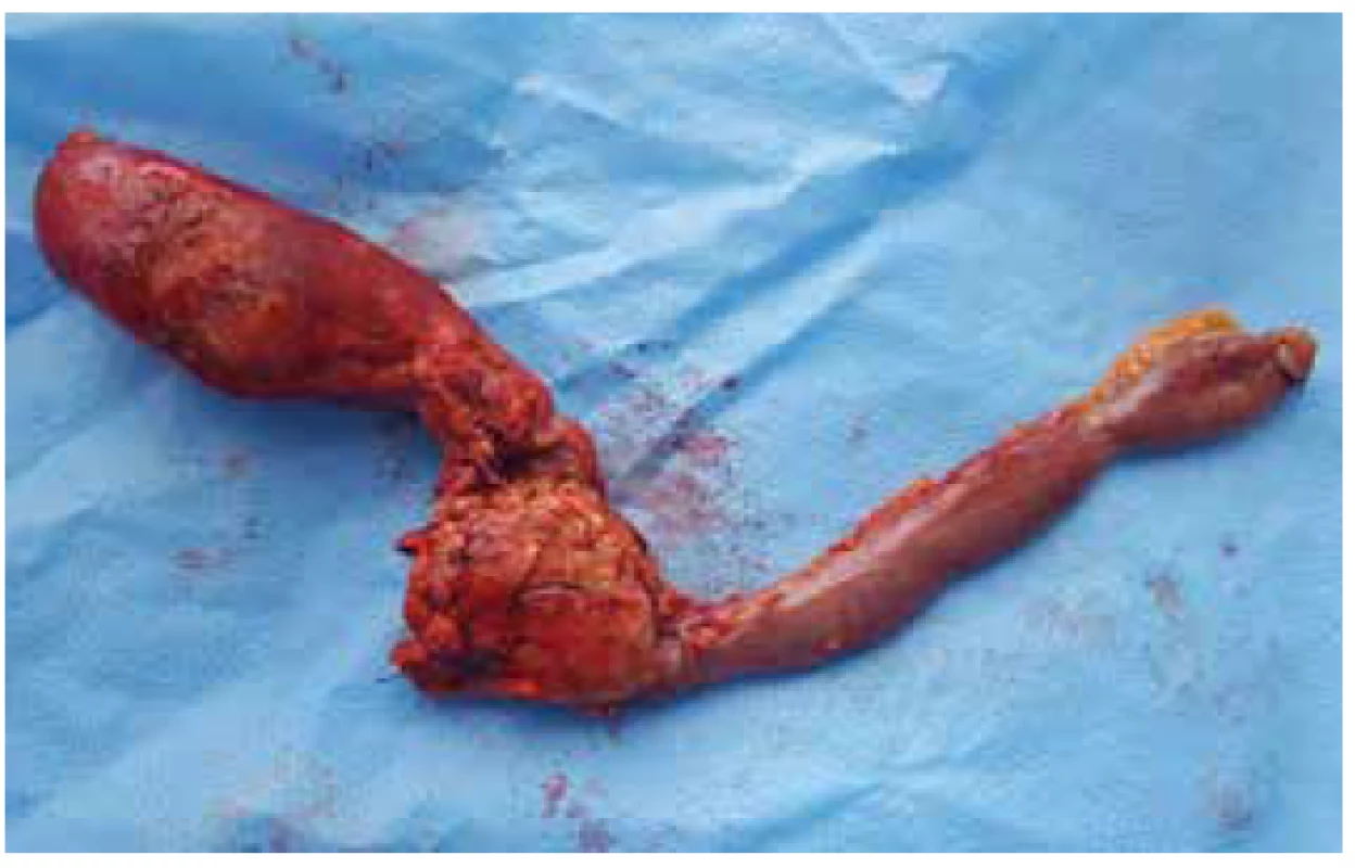 Preparát: žlučník, hlava pankreatu, duodenum in toto<br>
Fig. 5. Specimen: gallbladder, head of pancreas and duodenum
in toto