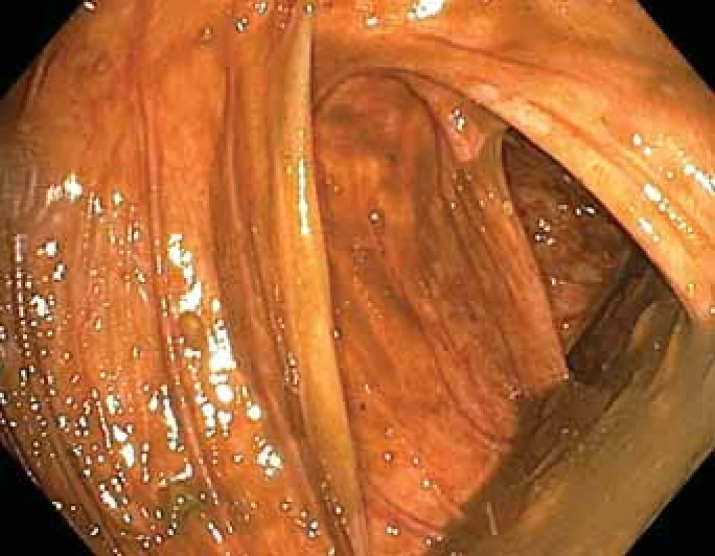 Totální enteroskopie – pohled do colon ascendens
z Bauhinské chlopně.<br>
Fig. 2. Total enteroscopy – reaching the ascending colon during enteroscopy from an oral approach.