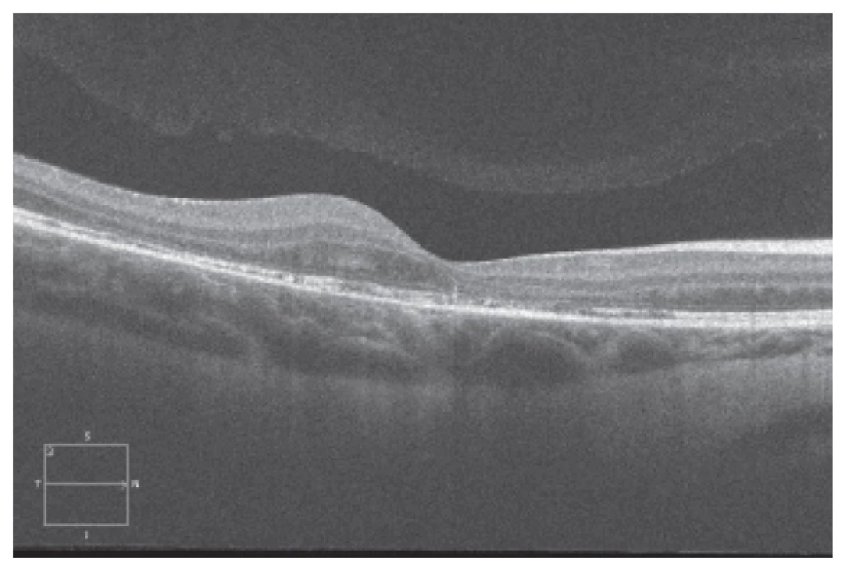 Spectral HD OCT Linear horizontal macular scan after 3 intravitreal
injections of ranibizumab (Lucentis) at long-term follow-up
(˃ 12 months) with stable macular finding, without progression