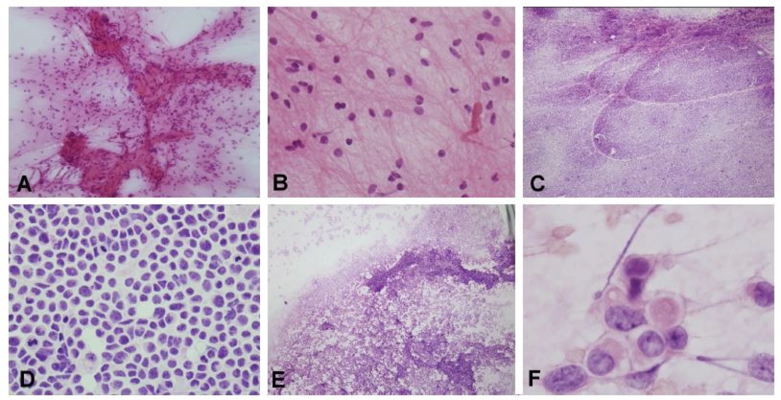 (A, B) Nádor mozočka u 6-ročného chlapca, s typickou radiologickou prezentáciou – cysta s kontrast-pozitívnym murálnym uzlíkom. V náterovej cytológii
bolo zrejmé, že sa jedná gliový tumor s cytologicky blandnými bunkami usporiadanými okolo abnormálnej cievy (pripomína mikrovaskulárnu proliferáciu
high-grade gliómov, ale stena je pravdepodobne hyalínne zmenená) (A). V detaile monotónna populácia s blandnými jadrami a dlhými piloidnými výbežkami.
Užitočným pomocným znakom je prítomnosť Rosenthalovych vláken. Peroperačná a definitívna diagnóza: pilocytický astrocytóm. (C, D) Solídny, kontrast-pozitívny
tumor mozočka u 5-ročného chlapca. Náter bol rovnomerný, išlo o léziu s nízkou kohezivitou nádorových buniek (C). Jednalo o malé bunky s minimom
cytoplazmy, „salt and pepper“ chromatínom, bez nápadnejších jadierok a početnými mitózami a apoptózami (D). Peroperačná a definitívna diagnóza: medulloblastóm,
klasický typ. U dospelého pacienta by pri podobnom náleze bola v diferenciálnej diagnóze na prvom mieste metastáza malobunkového karcinómu.
(E, F) Tumor IV. komory u 2–ročného chlapca. V náterovej cytológii boli zachytené jednak kohezívnejšie pseudopapilárne usporiadanie, celkovo však
bol náter diskohezívny (E). Vo veľkom zväčšení charakteristické rabdoidné bunky (F). Peroperačná a definitívna diagnóza: atypický teratoidný/rabdoidný tumor