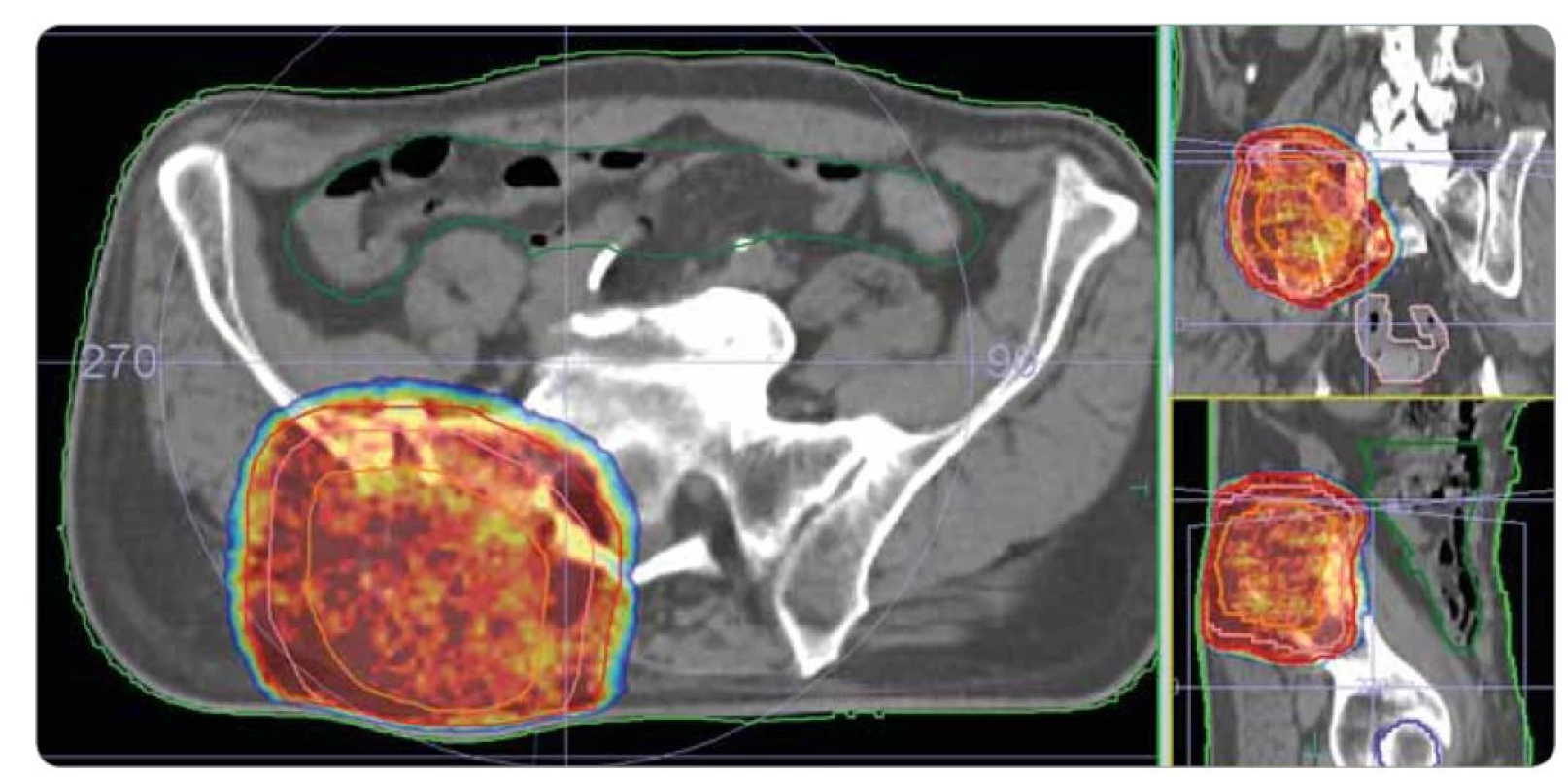 Ozařovací plán – paliativní radioterapie na oblast metastatického ložiska kosti kyčelní vpravo. Ozařovací technika radioterapie
s objemově modulovanou intenzitou (VMAT), přístroj Versa HD (Elekta). Předepsaná dávka: 30 Gy / 10 frakcí à 3 Gy. Kontury: oranžová –
nádorový objem (GTV), lososová – klinický cílový objem (CTV), červená – plánovací cílový objem (PTV), světle zelená – obrys těla, tmavě
zelená – střeva. Izodózy: červená – 100 % předepsané dávky, žlutozelená – 95 % předepsané dávky, modrá – 90 % předepsané dávky.