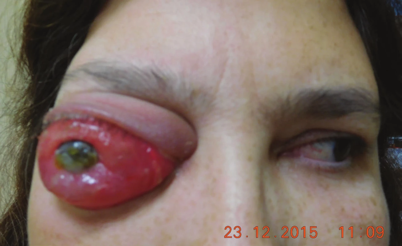 Clinical finding in 12/2015, eye globe prolabse through the
eyelid, progression of corneal lesion
