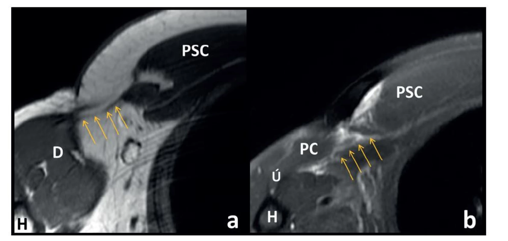 Ruptura šlachy m. pectoralis major na MR axiálních řezech<br>
Fig. 4: MRI axial sections of the pectoralis major rupture