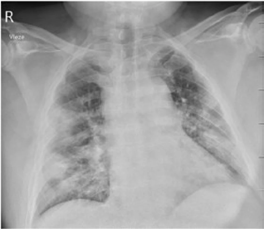 Rtg srdce a plic s nálezem zánětlivých infiltrátů v obou středních a dolních plicních polích