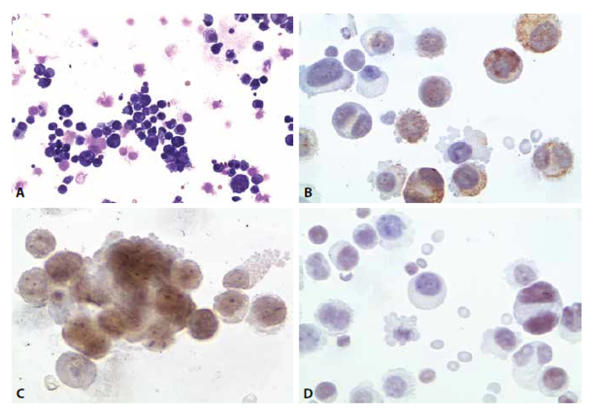 Ilustrační případ 4. (A) Nádorová pleocytóza. MGG 200x. (B) Pozitivita cytokeratinů. CKAE, 400x. (C) Pozitivita estrogenních receptorů.
600x. (D) Slabá pozitivita TTF1. 400x.