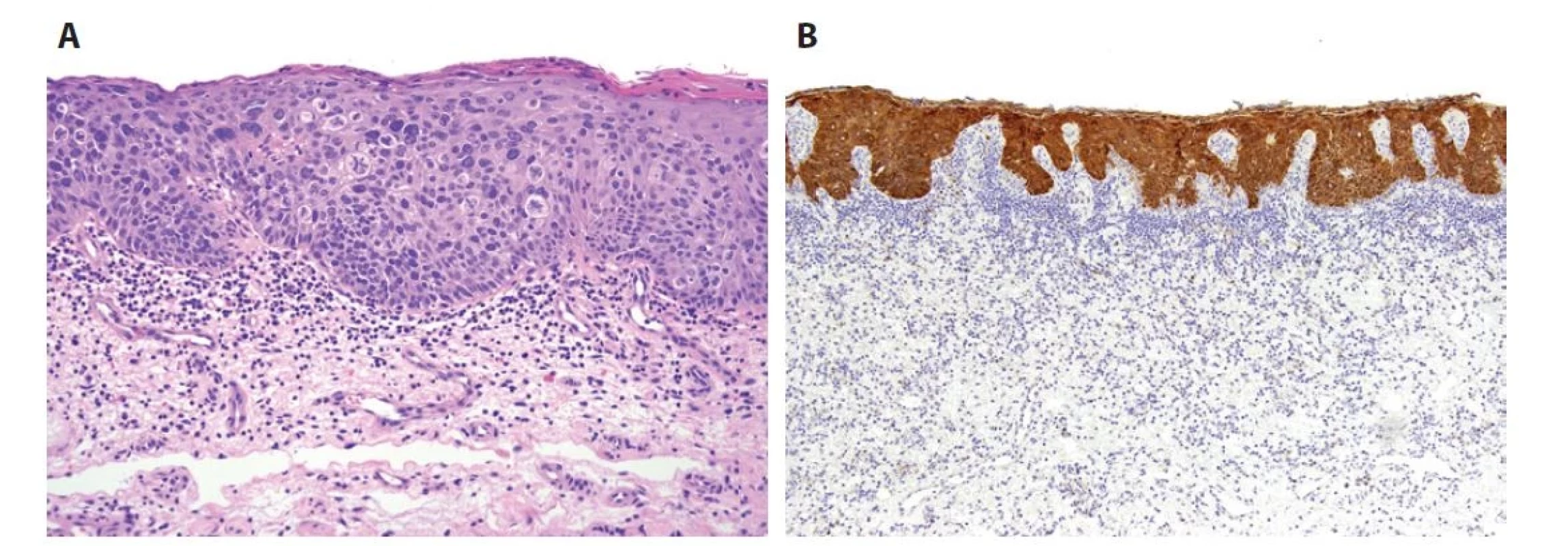 HSIL je v typickém případě identický HPV–asociovaným in situ lézím děložního čípku, vulvy či anu. Buňky povrchového epitelu vykazují
ztrátu stratifikace, nukleární atypie, zvýšený nukleocytoplazmatický poměr a mitotickou aktivitu (včetně atypických mitóz). Tyto změny se v případě
PeIN3 vyskytují v celé tloušťce epitelu (A). Diagnózu HPV-indukované léze potvrzuje silná bloková cytoplazmatická a nukleární pozitivita
s protilátkou p16 (B).