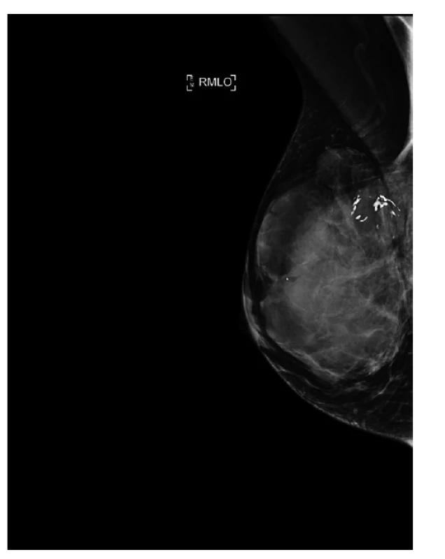 Mamograf, šikmá projekce, primární tumor, velikost
7cm, fixovaný ke kůži.<br>
Fig. 1: Mammogram, mediolateral oblique projection,
primary tumor, size 7cm, fixed to the skin.