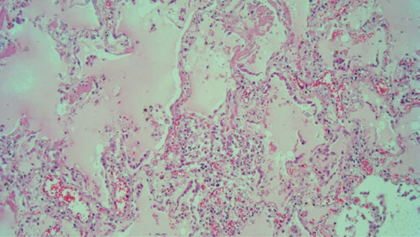 Histológia (horný lalok pľúc, HE, 100×) – prevažnú časť alveolárnych 
priestorov vypĺňa edémová tekutina. Prítomný je sýtoeozinofilne farbiaci 
sa materiál hyalínnych membrán a početné retiazky hyperplastických 
pneumocytov II. rádu, ktoré sú odlúpené, sú pleomorfné v dôsledku cytopatického efektu vírusu