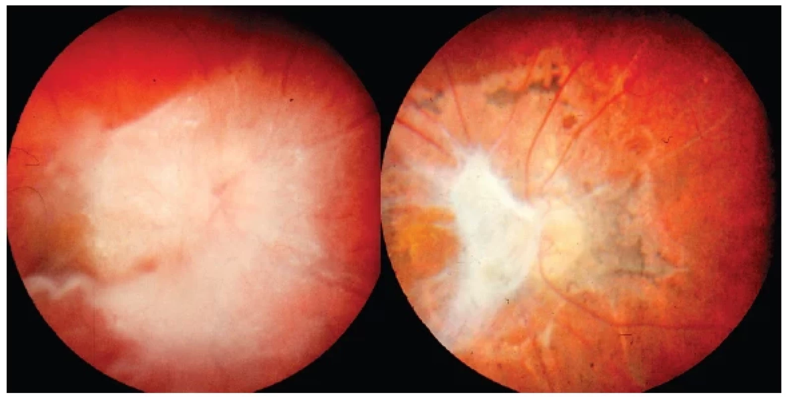 Vlevo: Obraz toxokarové neuropatie s vitritreální reakcí v okolí před celkovou
terapií
Vpravo: Výrazné jizevnaté sítnicové změny s atrofií papily zrakového nervu a zbytky vitreální
membrány po kombinované léčbě o rok později