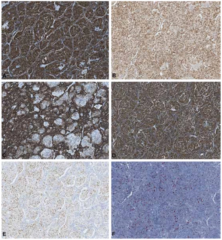 Immunohistochemical study. A: CK7, membranous expression by the two cells population. B: PAX8, nuclear expression by the two cells types. C: AMACR. D: Vimentin. E: Cyclin D1, nuclear expression only by large cells. F: Ki67, nuclear expression