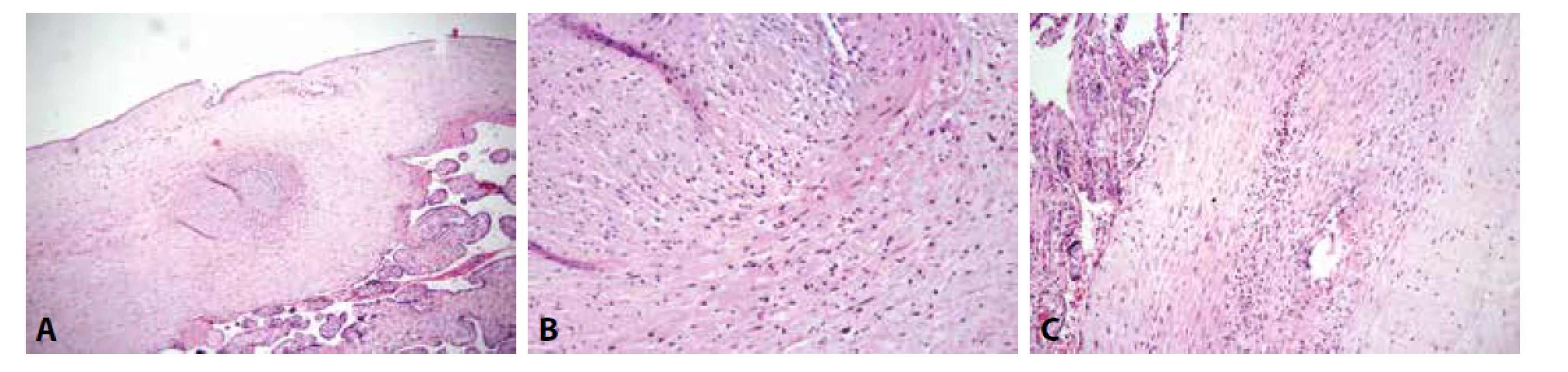 ETCV. A: Zánětlivá celulizace ve stěně cévy choriové plotny s organizovanou nástěnnou trombózou (HE, 100x). B: Zánětlivá celulizace tvořená lymfocyty
a ojedinělými eosinofilními granulocyty (HE, 200x). C: Výraznější příměs eosinofilních granulocytů v zánětlivém infiltrátu patrná po prokrájení parafinového
bloku (HE, 200x).