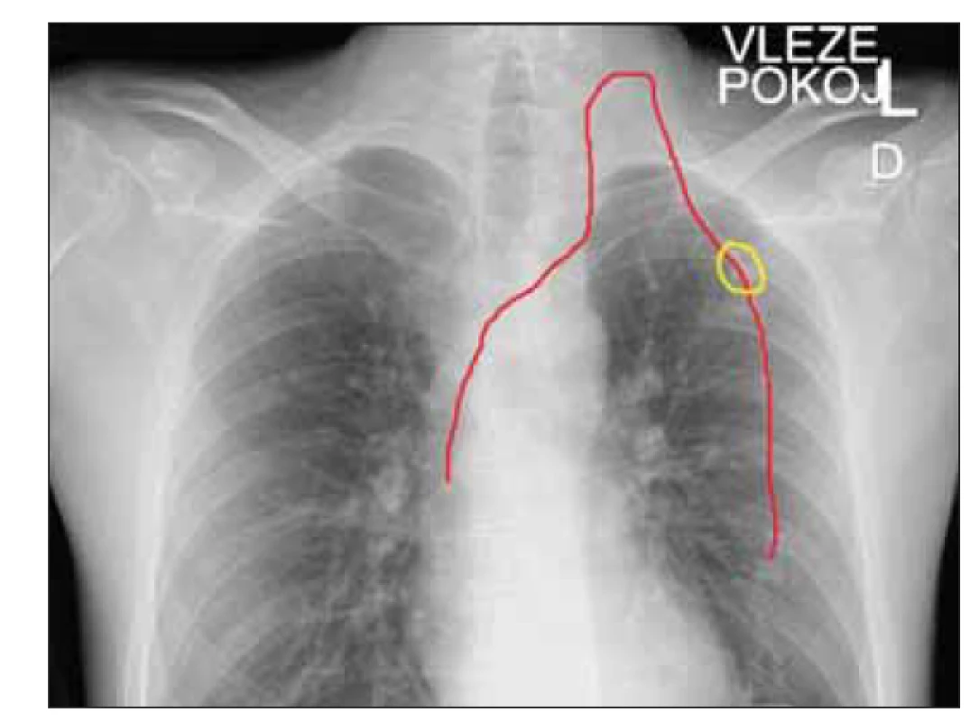 RTG hrudníku u pacienta po alternativní implantaci
periferně zaváděný centrální katetr cestou levé v. jugularis
s tunelizací podkožím na hrudník do subklavikulární
oblasti, katetr pro zvýšení přehlednosti zvýrazněn
červenou barvou, žlutě zvýrazněna pozice výstupu
katetru z podkoží a umístění fi xačního systému.