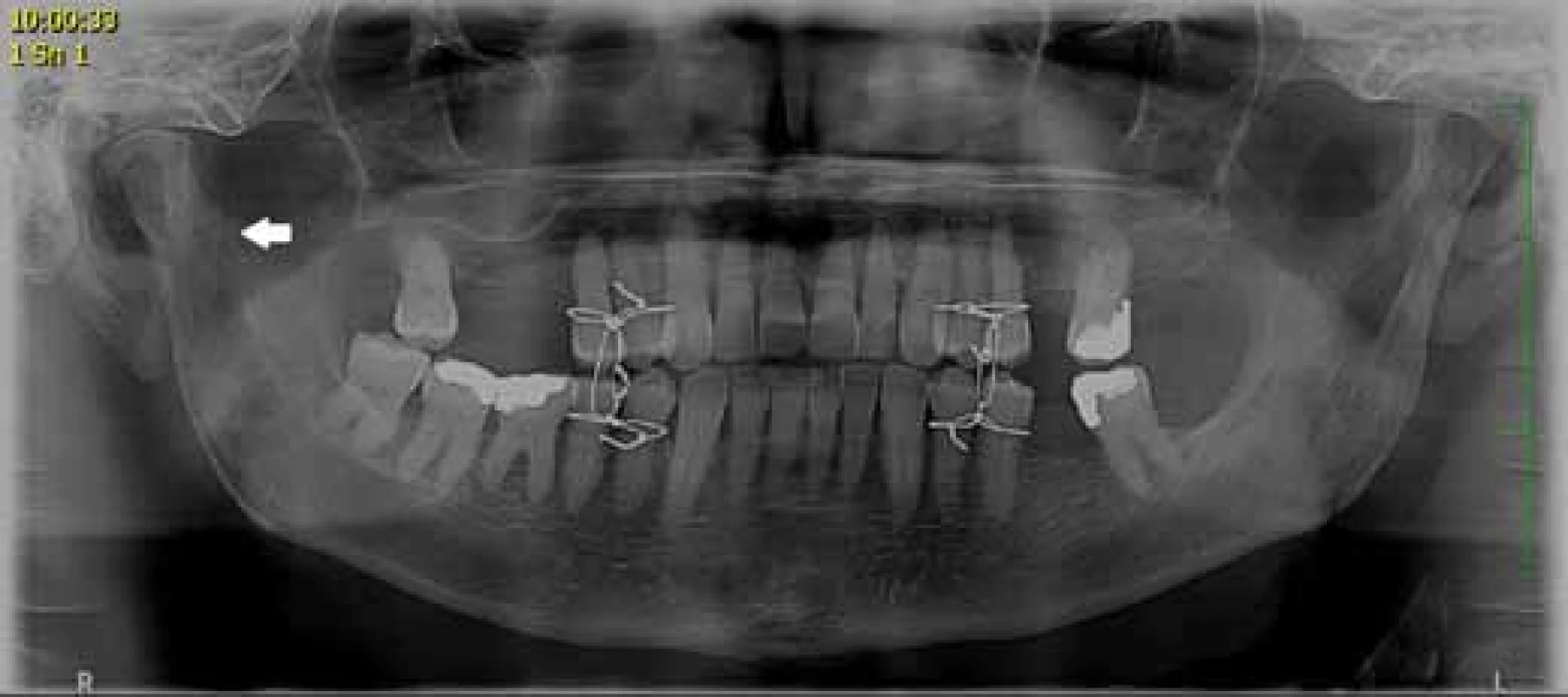 Pacient s nedislokovanou frakturou kloubního výběžku mandibuly s navázanou pevnou mezičelistní fixaci (konzervativní terapie)