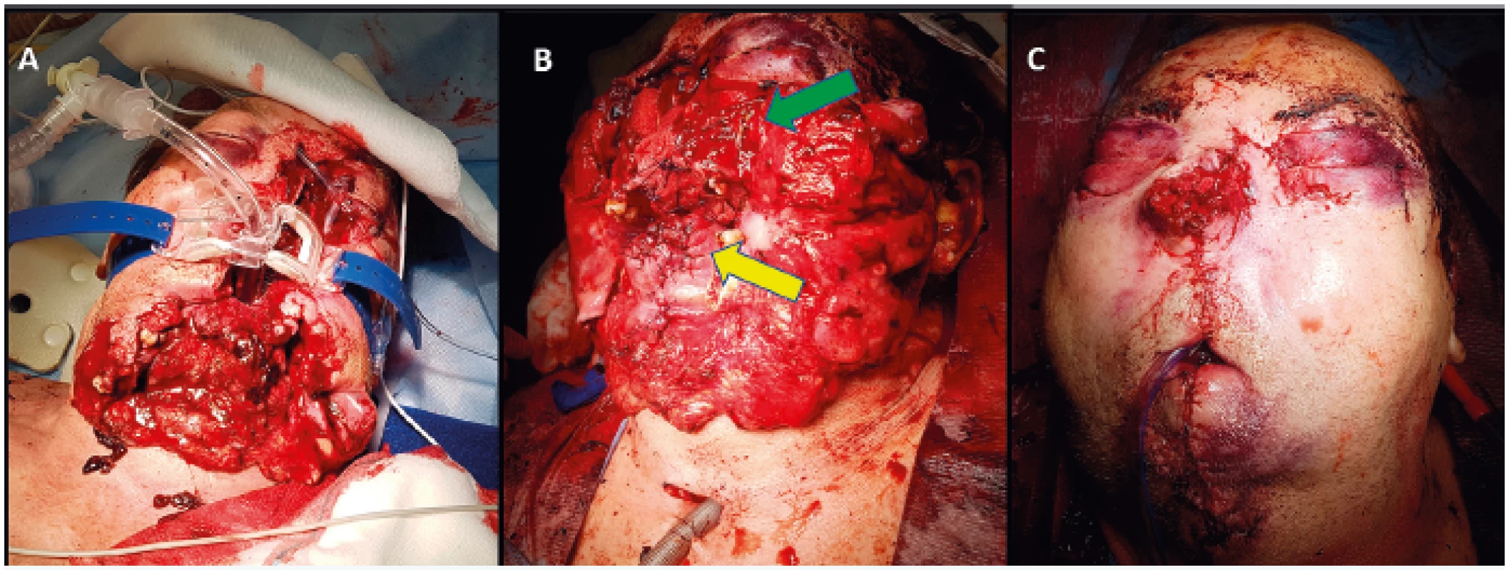 A) A patient intubated through his mouth following a gunshot injury to the face who was brought to the Accident & Emergency Unit, University Hospital Ostrava. The rigid cervical collar was already removed following a CT examination. B) The patient in the surgical theatre with tracheostomy and nasal packing due to bleeding; the green arrow indicates a primarily reconstructed maxilla and palate, the yellow arrow a reconstructed tongue. A loss injury to the mandible is obvious. C) Primary reconstruction of the face, nose and mouth; the lack of soft tissues is apparent (microstoma, notable lack of the nasal tissues)