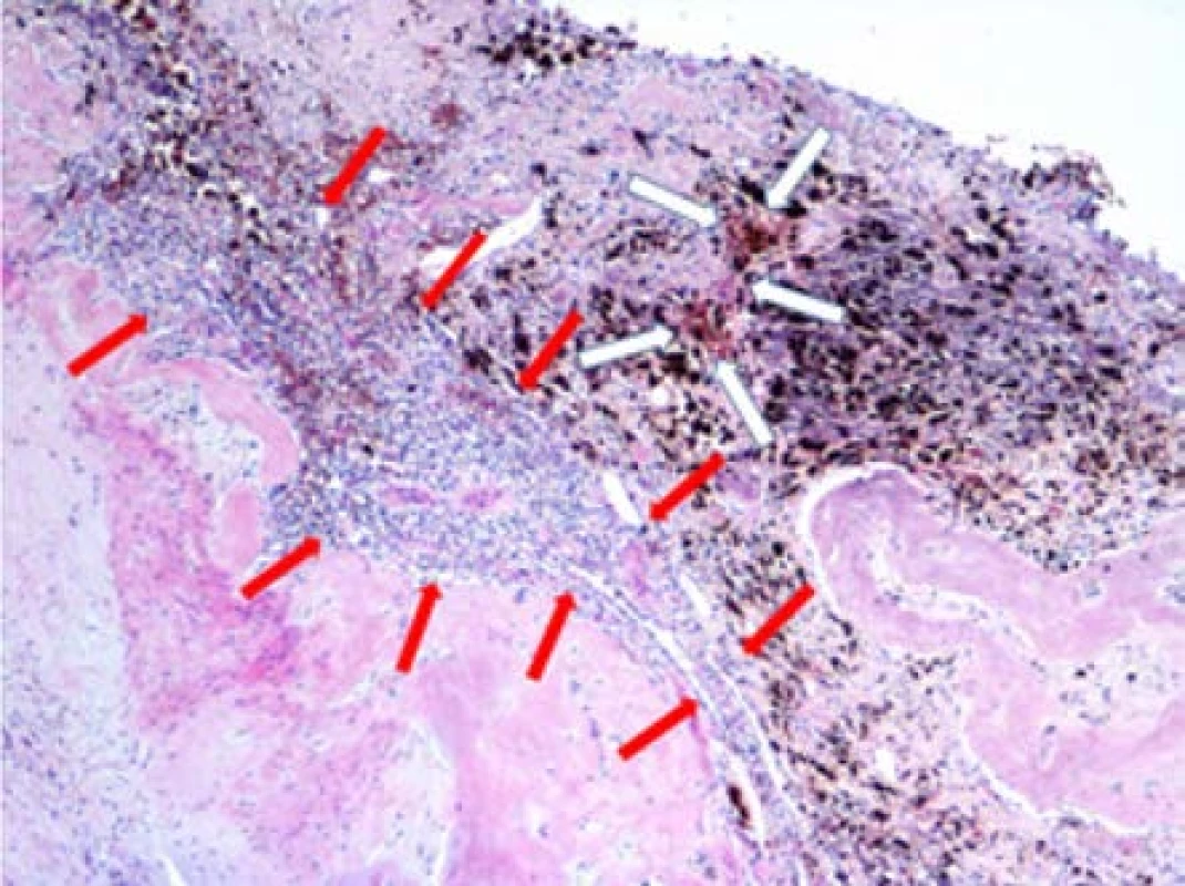Zbytky světlobuněčného karcinomu (označeno
červenými šipkami), bílé šipky ozačují ložiska hemosiderinu,
nejspíše související s organizací krevních sraženin
v místě regrese nádoru po léčbě; původní zvětšení x40,
hematoxylin-eosin<br>
Fig. 4. Residuals of clear carcinoma (marked with
red arrows), white arrows mark hemosiderin foci, most
likely related to the organization of blood clots at the
site of tumor regression after treatment. Original magnification
x40, hematoxylin-eosin