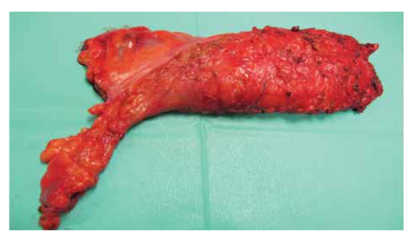 Fotografie resekátu – roboticky asistovaná resekce rekta s TME.<br>
Fig. 3. Resection photography – robotically assisted rectal resection with TME.